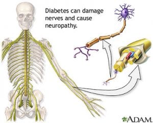 Defining Neuropathy And How It Relates To Diabetes