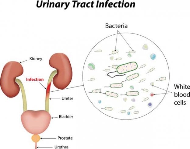 Diabetes and Urinary Tract Infections