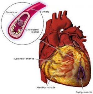 Heart Disease And Diabetes