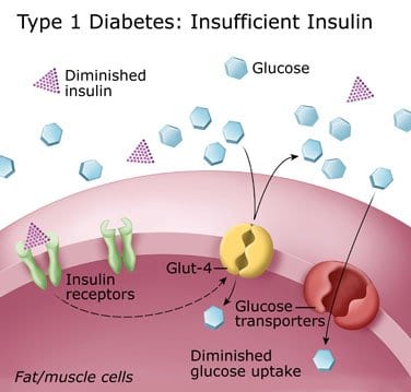 Long Term Effects Of Badly Managed Diabetes