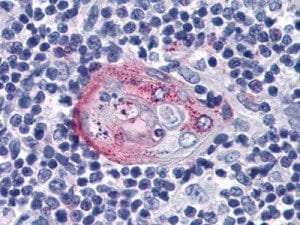 Genetic Mutation Causes Rare Form of Hypoglycemia