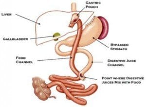 Significant Long-Term Benefits Associated with Gastric Bypass Surgery