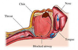 Study Shows Lifestyle Interventions for Weight Loss Also Reduce Sleep Apnea in Type 2 Diabetics
