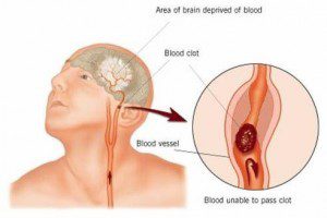 Ten-Year Diabetics at Significantly Increased Risk of Stroke