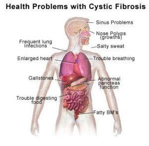 How Cystic Fibrosis-Related Diabetes Differs from Type 1 and Type 2