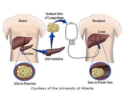 New Information on Islet Cell Transplantation